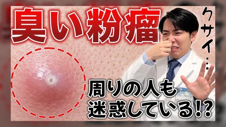 アイキャッチ（粉瘤って臭いですか？）
