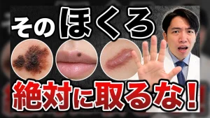 取ってはいけないほくろに関するサムネイル