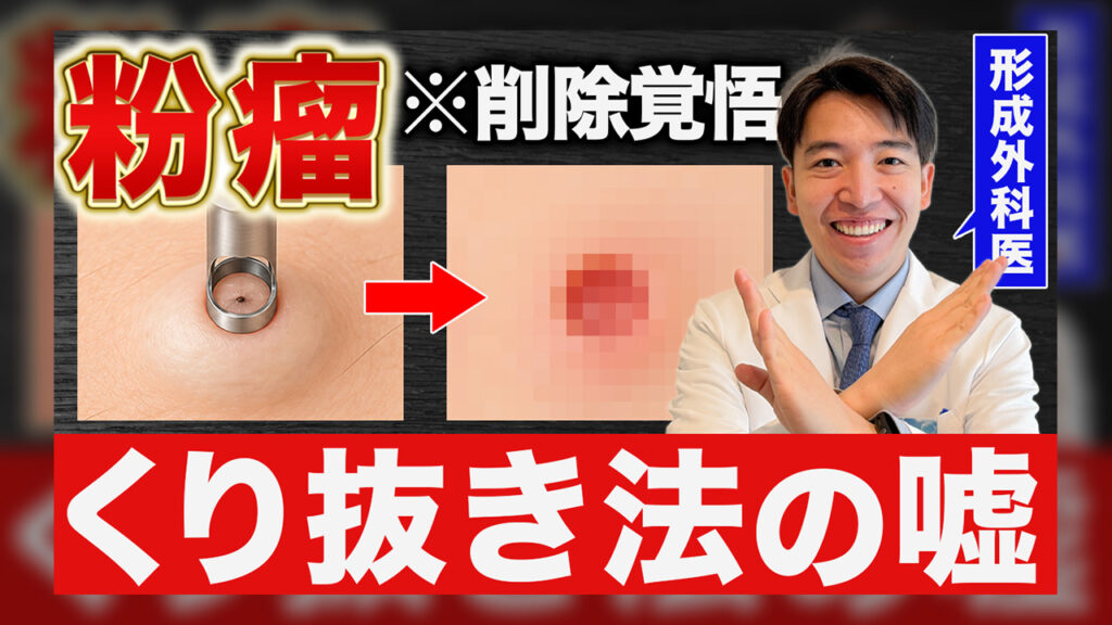 粉瘤のくりぬき法の嘘サムネイル