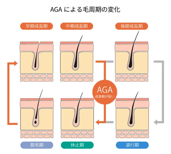 AGAによって毛の成長期が短くなる毛周期の変化