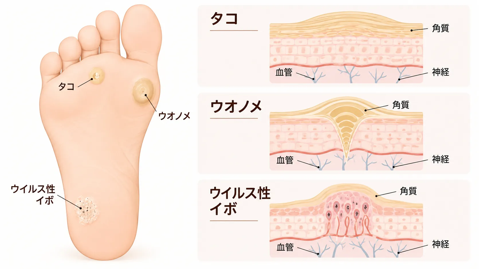 足裏のタコ・ウオノメ・ウイルス性イボの違いを比較した図