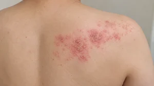 帯状疱疹（背中・肩の症状画像